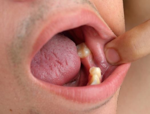 Closeup of smile with missing tooth