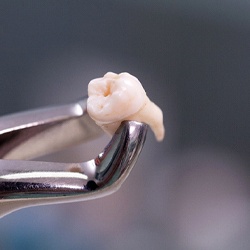 Extracted tooth in Phoenix