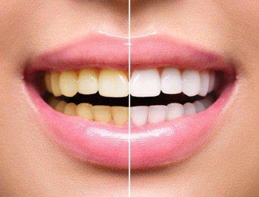 Closeup of smile before and after teeth whitening